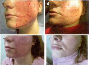 етапи відновлення шкіри після процедури фракційної абляції