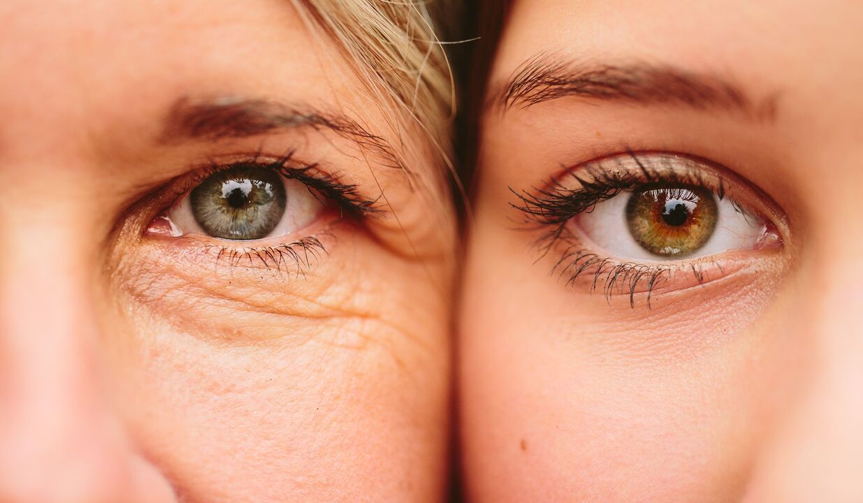 ознаки старіння навколо очей