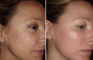 лазерне омолодження шкіри обличчя фото до і після